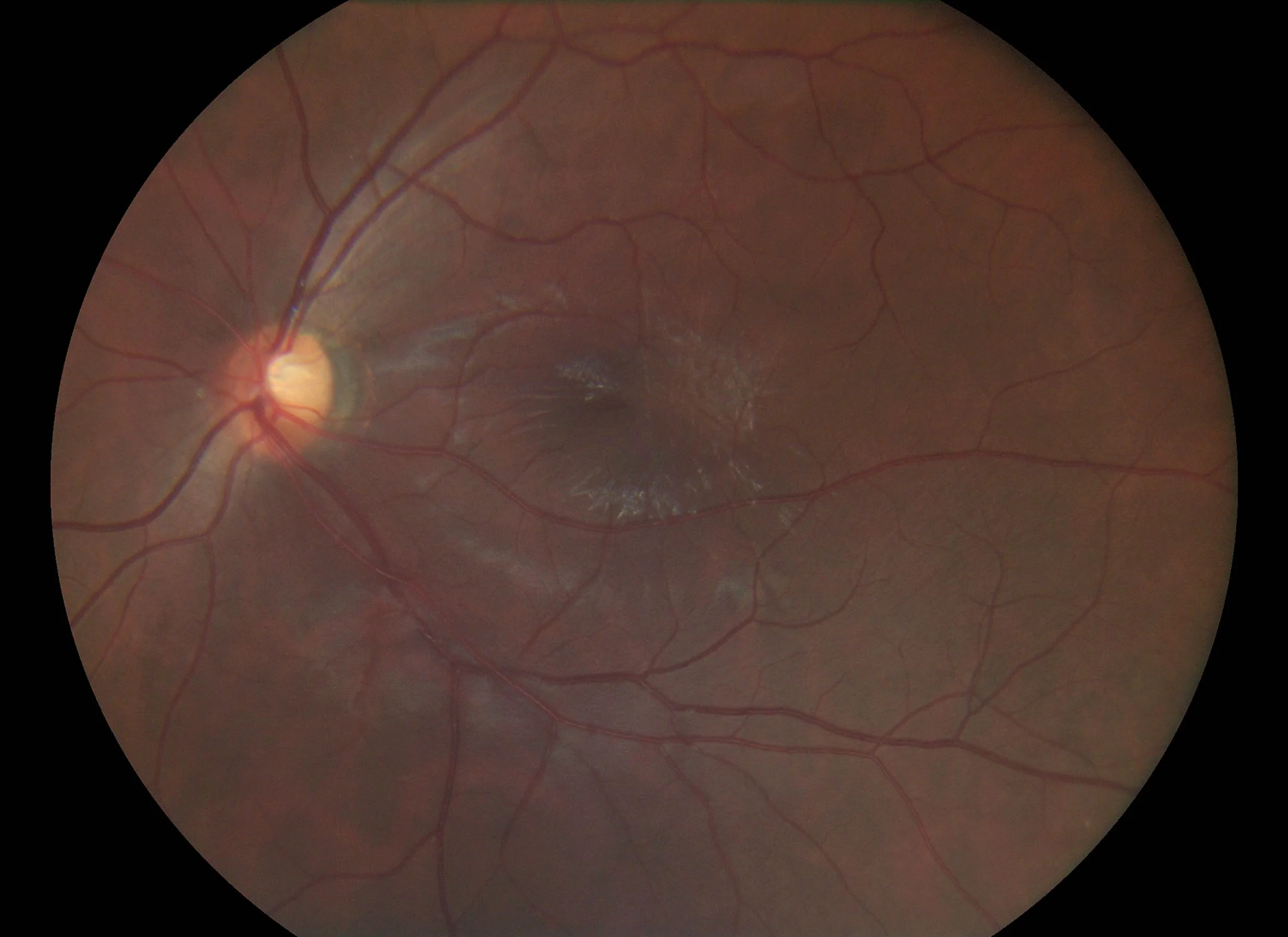 Pictor Prestige™ Handheld Fundus Camera with Optional Anterior Module - Image 3