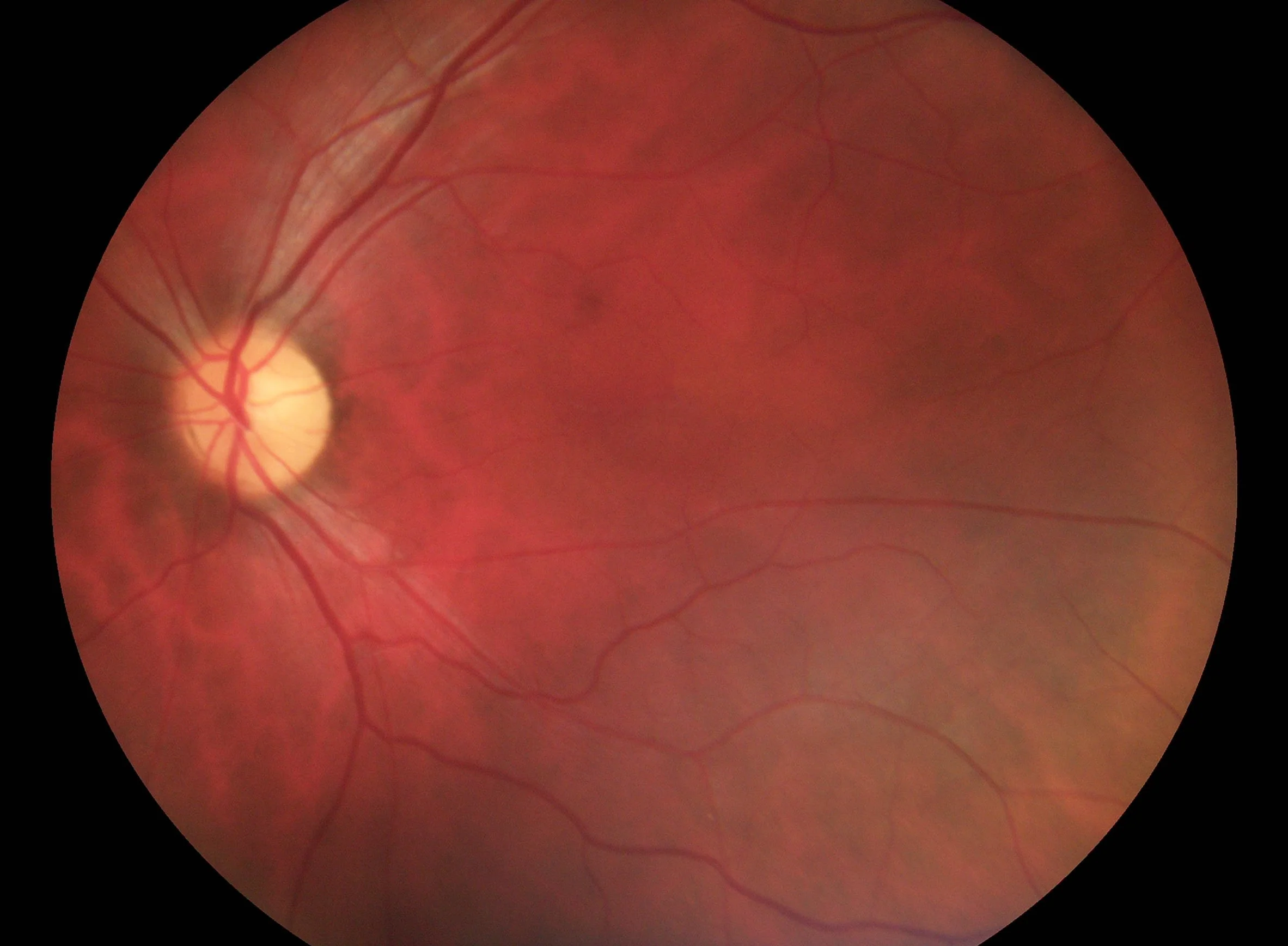 Pictor Prestige™ Handheld Fundus Camera with Optional Anterior Module - Image 5