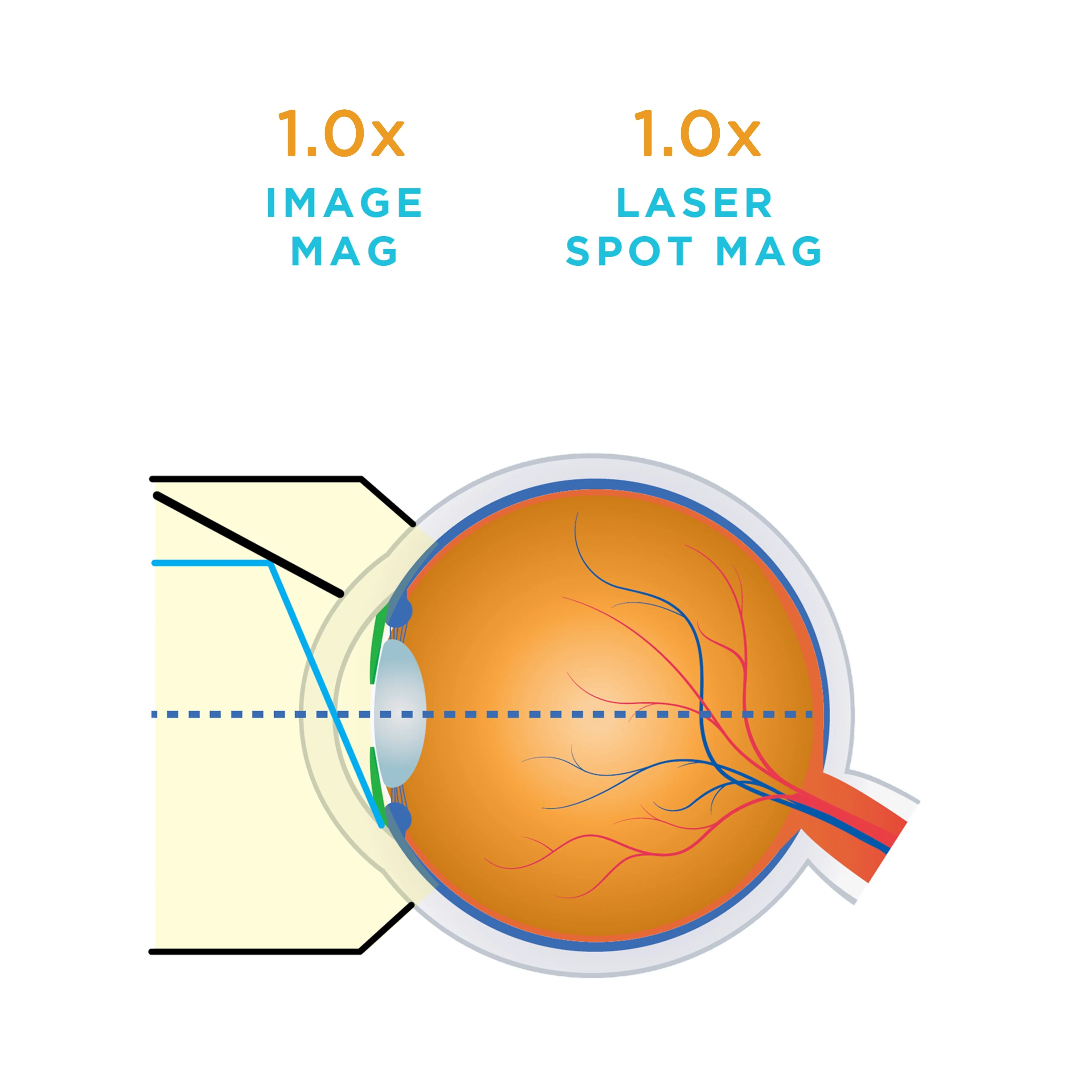 Rapid SLT Lens - Image 4