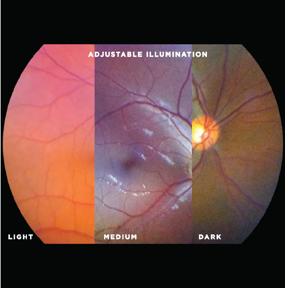 VistaView™ Mydriatic Portable Fundus Camera - Image 3