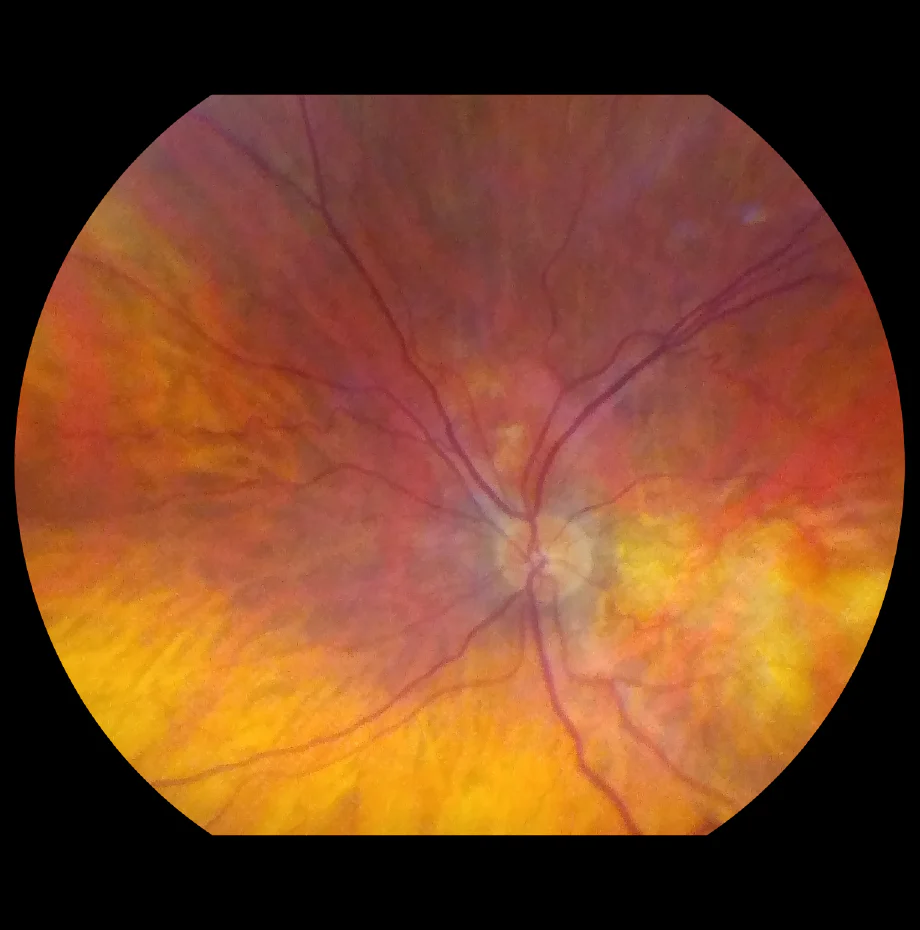 VistaView™ Mydriatic Portable Fundus Camera - Image 4